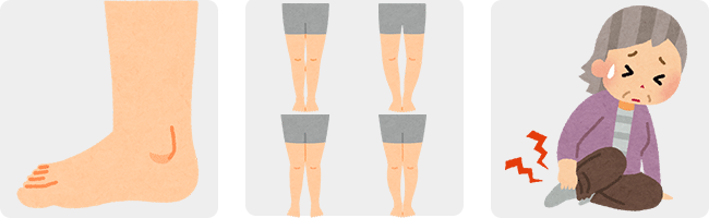 リウマチ足、変形性関節症（O脚や X脚）、足底筋膜炎、糖尿病足